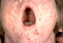 有什么可以影响水痘在成年人？