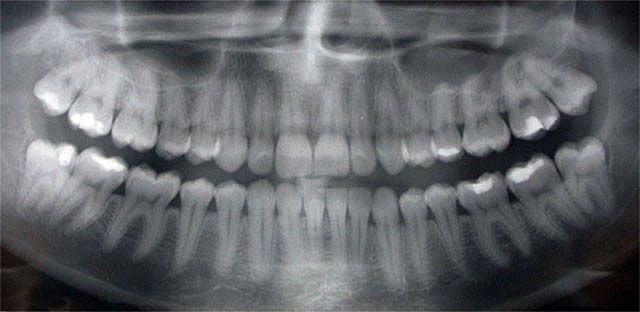 radiografía de la captura de los dientes