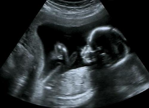 Transcript ultrasound 2 trimester