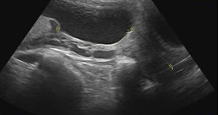 2nd trimester ultrasound