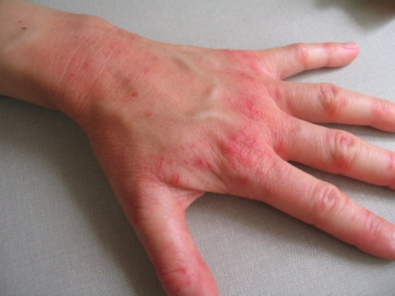 Skin eczema treatment
