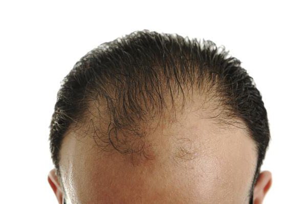 is there a cure for androgenic alopecia