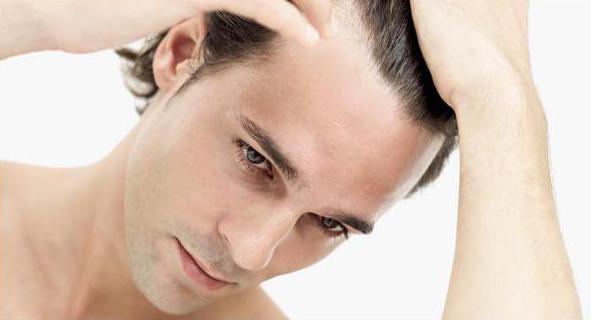 alopecia androgenética em homens