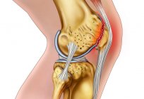 弯月的膝：症状和损伤的治疗