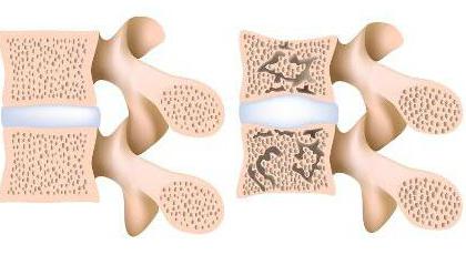 Osteoporose der Wirbelsäule Symptome und Behandlung