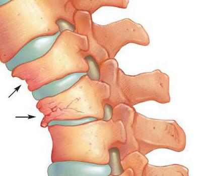 Osteoporose der Wirbelsäule Symptome und die Behandlung der Volksmedizin