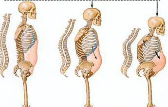 остеопороз шийного відділу хребта симптоми і лікування