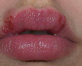 herpes nos lábios o tratamento da causa e prevenção de doenças