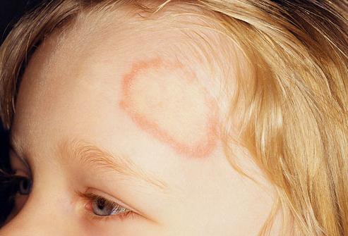 remedy for shingles in children
