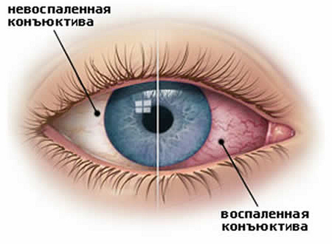 Inflamação dos olhos