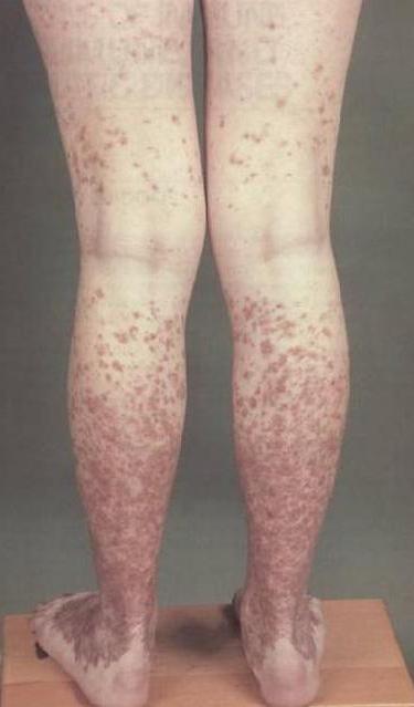 disease of samburga