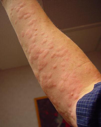 Hives is contagious or not,
