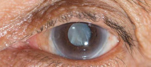 treatment of early stage of cataract