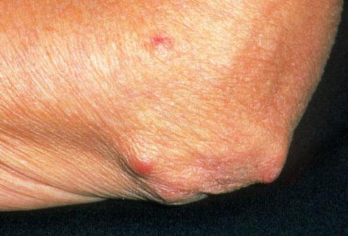Rheumatoid nodule on elbow