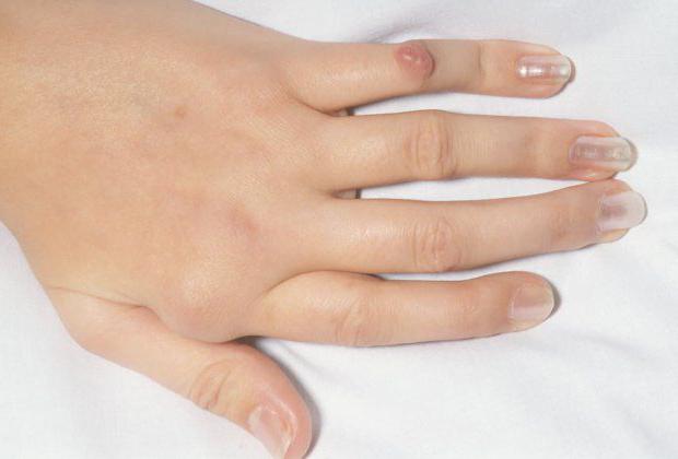 Reumatoide nudo en el dedo
