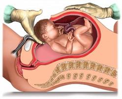 cesarean section pros and cons