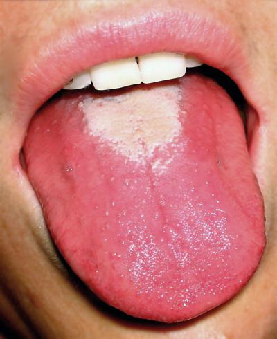 white tongue how to treat