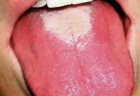 White tongue is a sign of what? Understand together