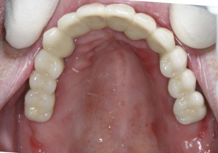 歯科補綴物ACRIイドポテト