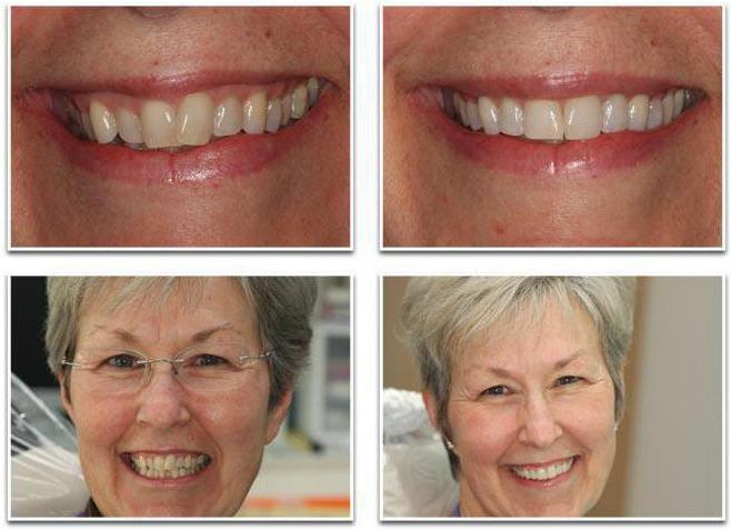 Zahnspange am Unterkiefer Foto vor und nach der