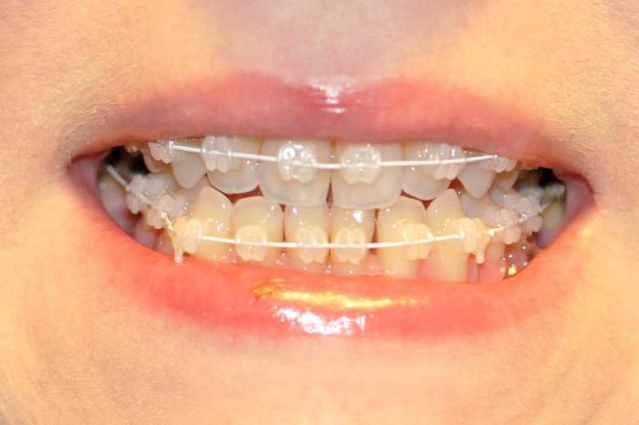 Braces for upper and lower jaw