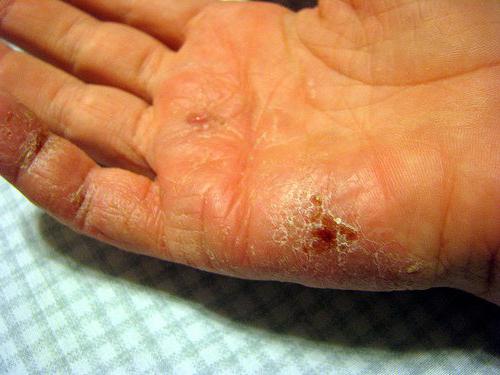 treatment for eczema on hands symptoms and causes
