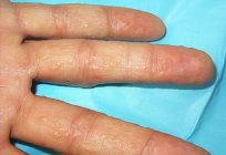 Sulu kabarcıklar, parmaklar: belirtiler ve tedavi