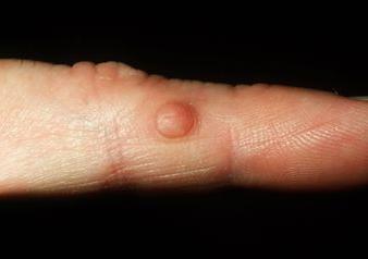 la enfermedad de las articulaciones de los dedos de las manos