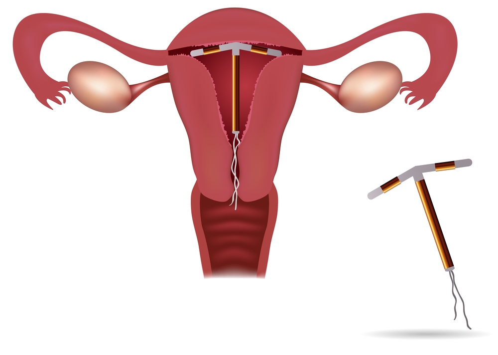 внутириматочная Spirale in der Gebärmutter