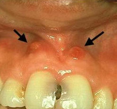 the flux on the gums treatment at home