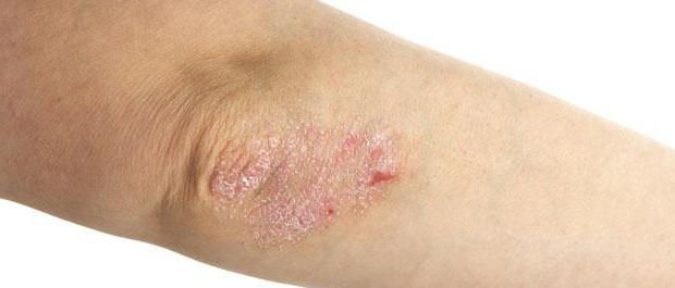 pills methotrexate for psoriasis reviews
