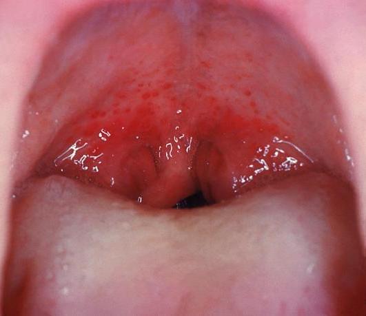 the tonsils in scarlet fever