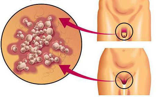 nasıl oluşur genital herpes