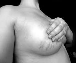 Schwangerschaftsstreifen auf der Brust