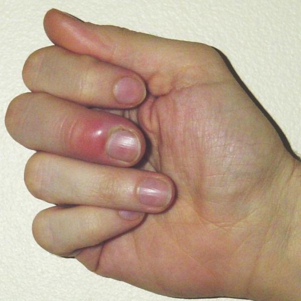 festers finger near the nail