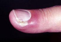 Lo que se puede hacer en caso de que нарывает el dedo cerca de la uña