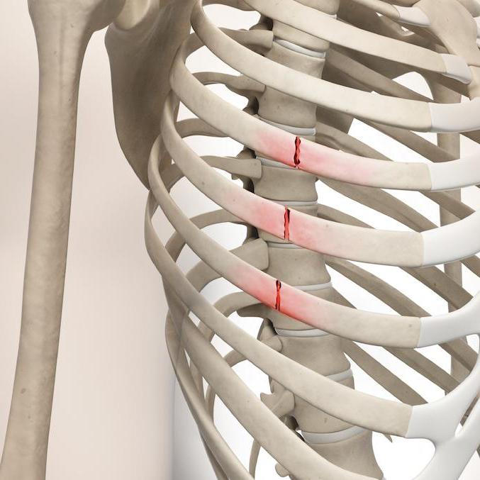 скільки гояться ребра після перелому у людини
