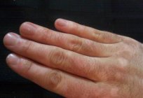 Vitiligo - what is it? Causes, symptoms and treatment vitiligo