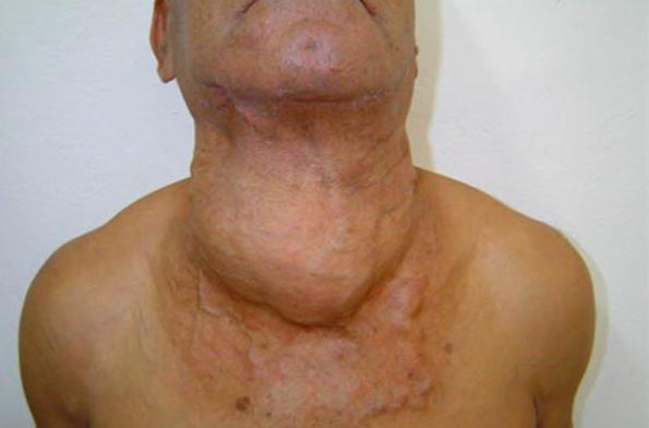 Hodgkin-Lymphom noduläre Sklerose