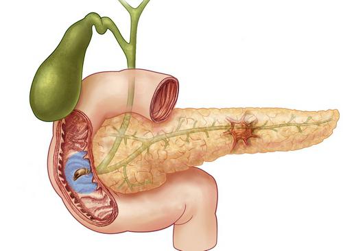 la enfermedad del páncreas tratamiento