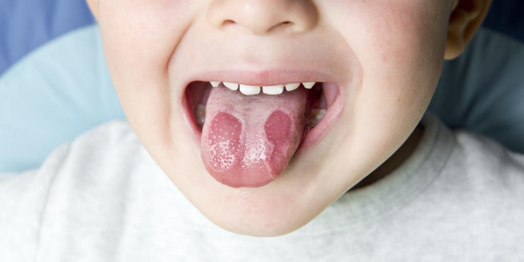 Entzündung der Zunge