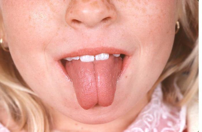 一舌头肿胀在刺穿后，照片