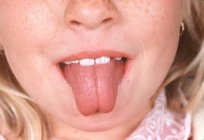 舌头肿胀的原因和后果