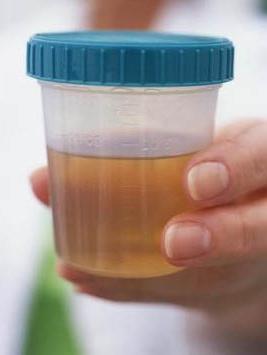 die Allgemeine klinische Analyse des Urins