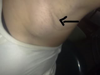 enlarged lymph node armpit