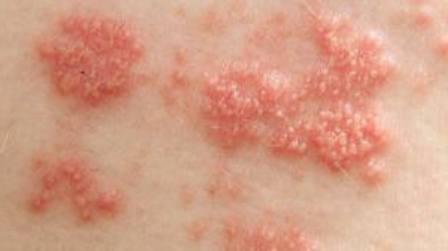 what is shingles