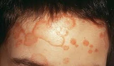 what is ringworm in humans