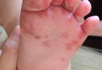 皮疹在棕榈树和鞋底在一个儿童：可能的原因和治疗