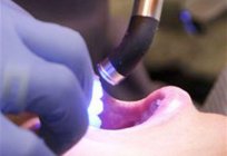مصباح علاج الأسنان: لماذا هو ضروري وكيفية تحديد ذلك ؟ 