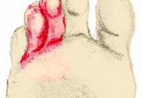 O czym świadczy oniemiały duży palec u nogi